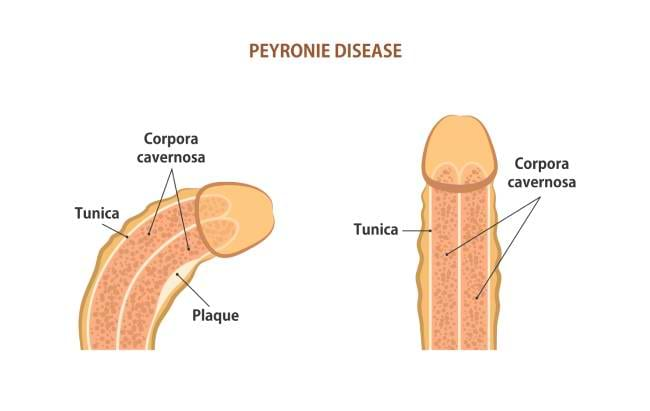 Peyronie’s disease